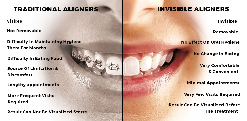 Clear Aligners in sanford
