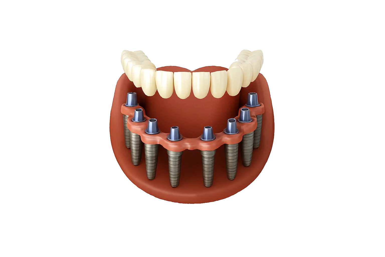 Full Mouth Rehabilitation